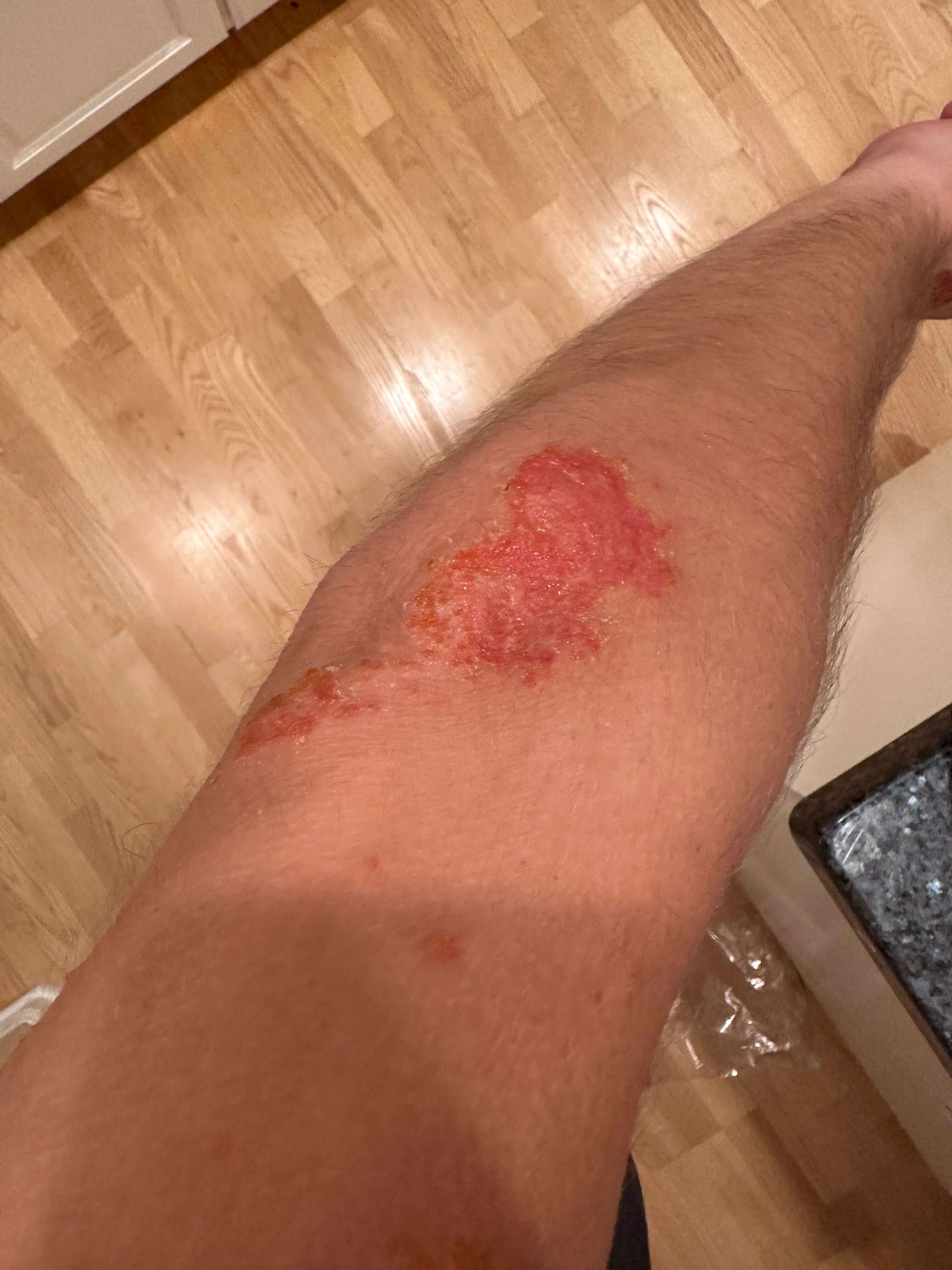 Eczema wound on arm
