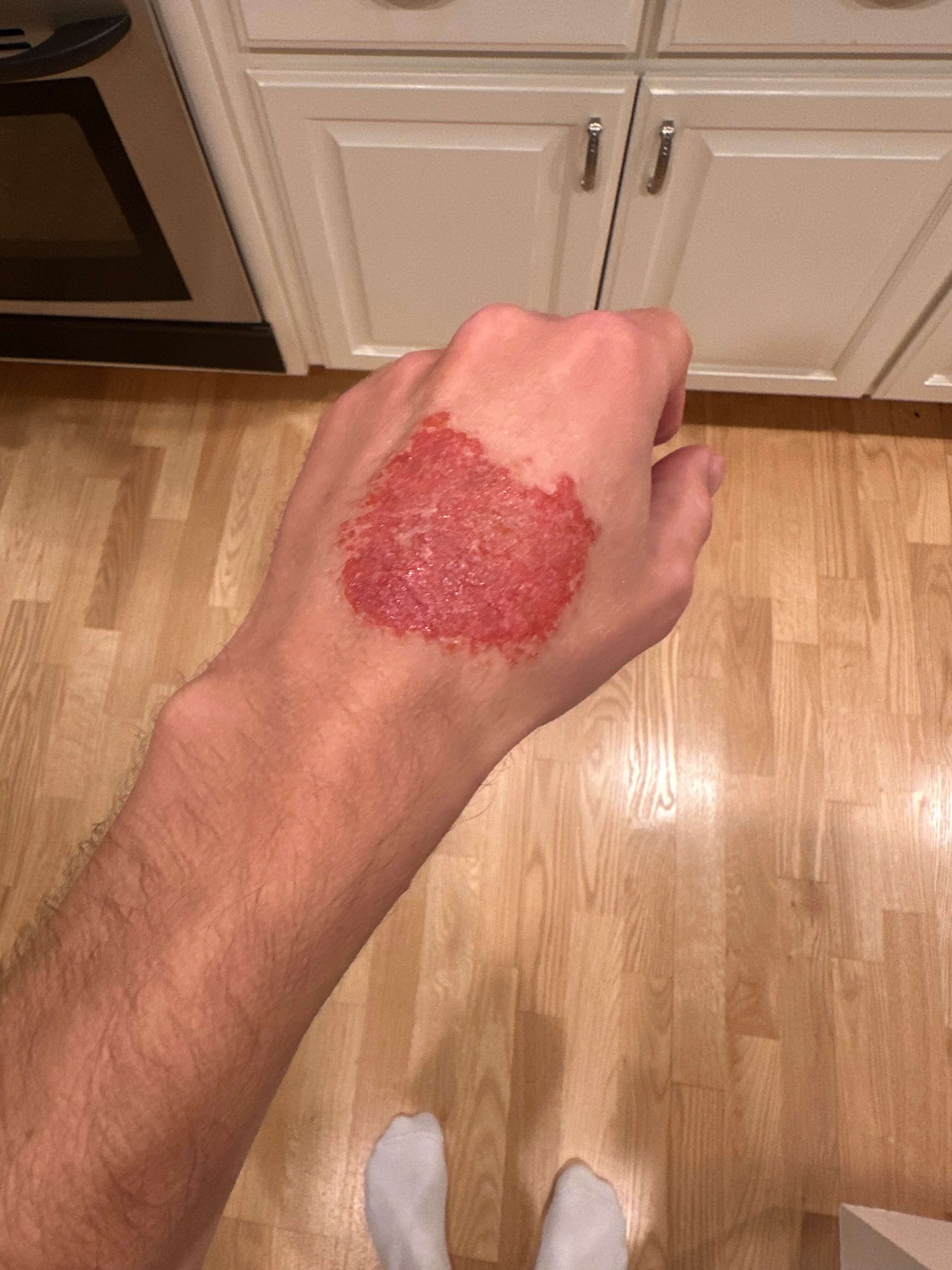 Hand dermatitis